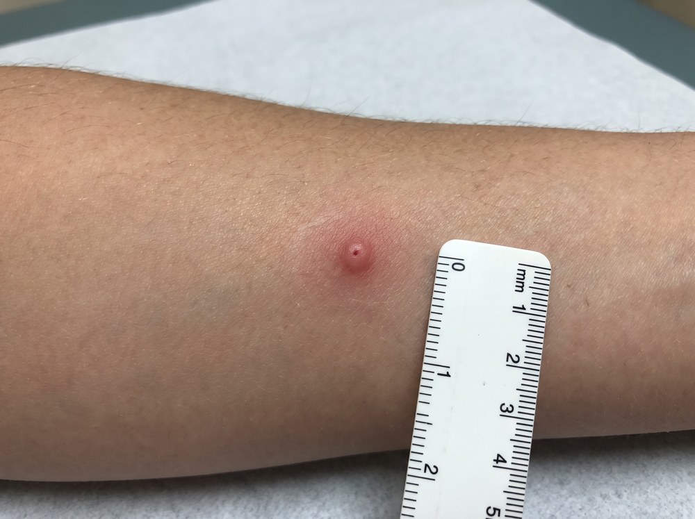 Close-up photo of a small red swollen bump on skin representing a mild jumping spider bite a few hours after it happened