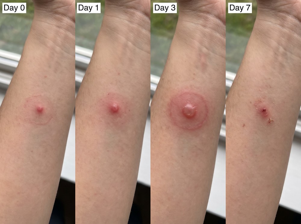 Four panel comparison photo showing a jumping spider bite fading from red and swollen on day zero to nearly invisible by day seven